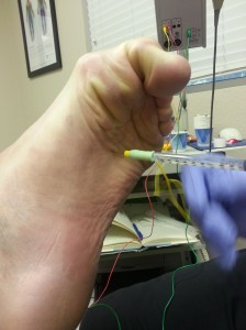 Notice that the bottom of my foot STILL has a needle in it